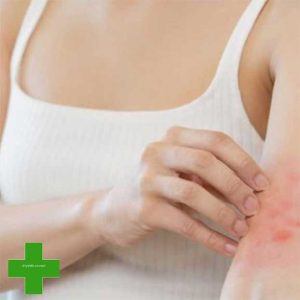 Infected Insect Bites