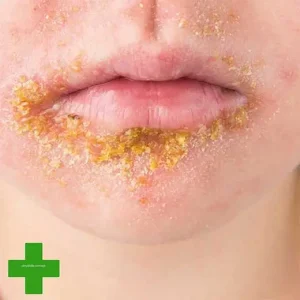 Impetigo