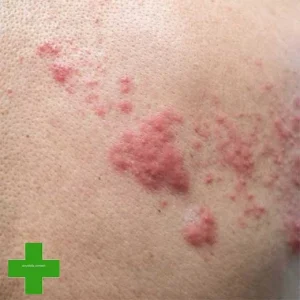 Shingles